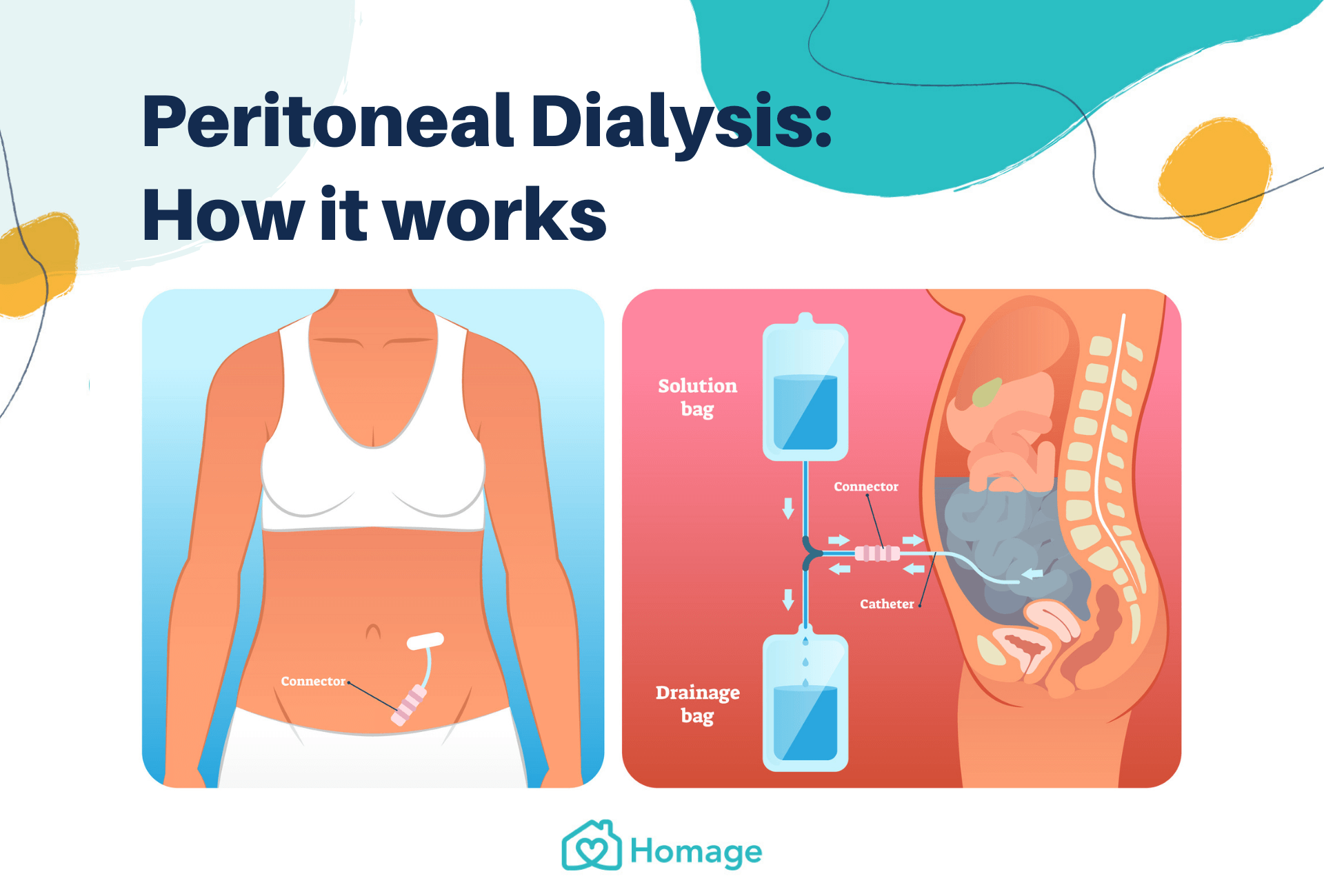 pd dialysis travel