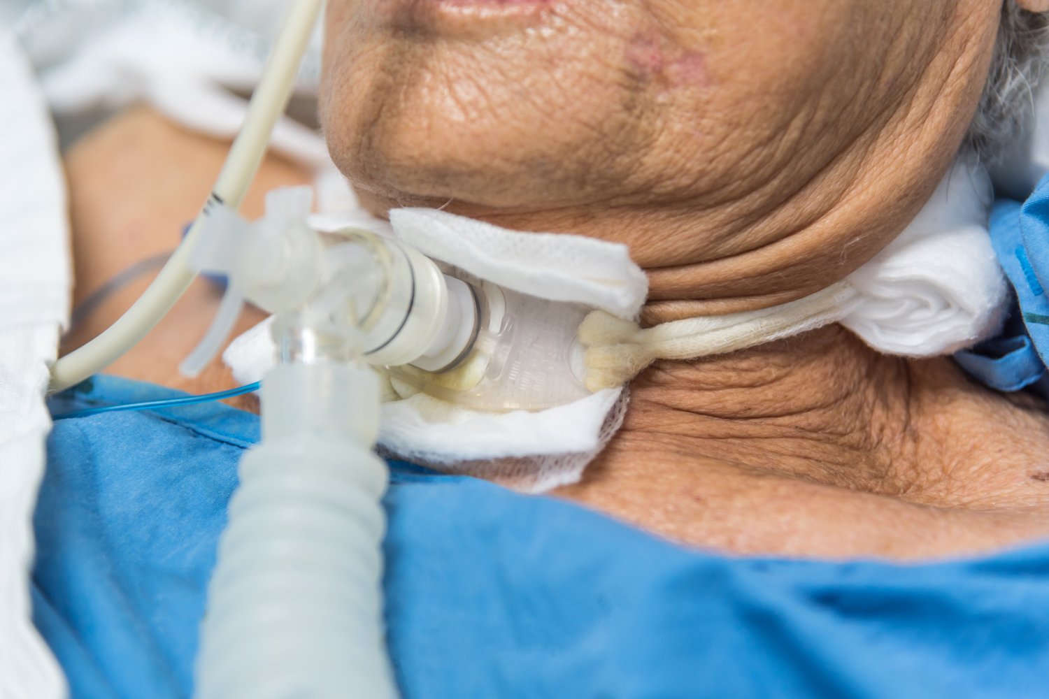elderly woman with tracheostomy tube